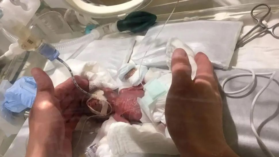Nació con 268 gramos y sobrevivió