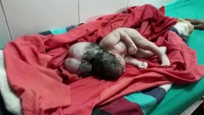 Nació una bebé “con tres cabezas” y generó conmoción