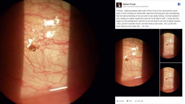 Le picaba el ojo y le encontraron una garrapata