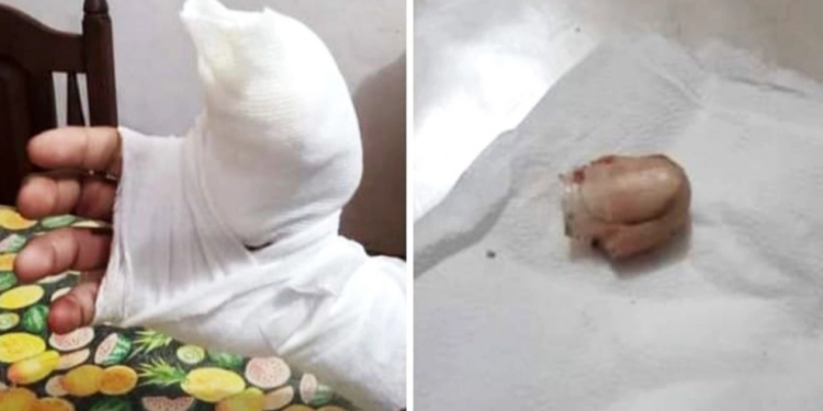 Policía se defendió de un ladrón y le cortó el dedo de un mordiscón