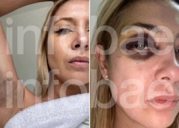 Impactantes imágenes de los golpes que denunció Fabiola Yañez de Alberto Fernández