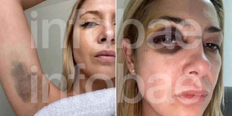 Impactantes imágenes de los golpes que denunció Fabiola Yañez de Alberto Fernández