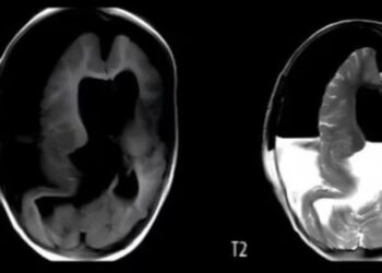 Impactante caso: muere bebé con un feto creciendo en su cráneo