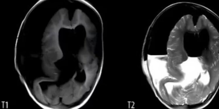 Impactante caso: muere bebé con un feto creciendo en su cráneo