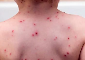 Alarma por el brote de sarampión: crecen los casos y hay preocupación