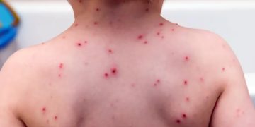 Alarma por el brote de sarampión: crecen los casos y hay preocupación