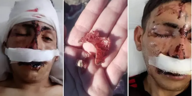 Se negó a darles dinero para comprar vino y le desfiguraron la cara a ladrillazos