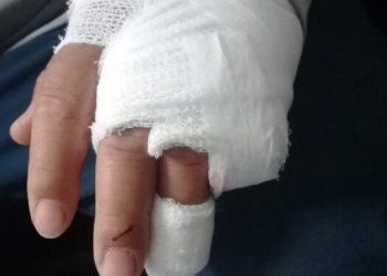 Caucete: trabajador municipal perdió un dedo en un accidente y denuncian precariedad laboral