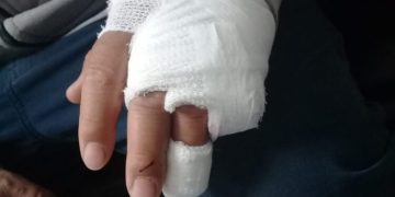 Caucete: trabajador municipal perdió un dedo en un accidente y denuncian precariedad laboral