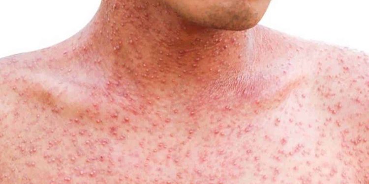 Sarampión: hay alerta epidemiológica tras cuatro casos en el país