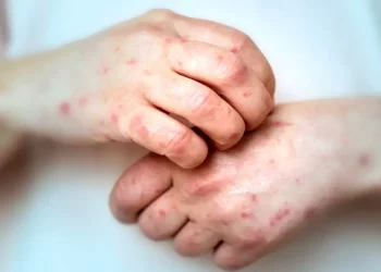 Argentina atraviesa un aumento sin precedentes en los casos de sífilis