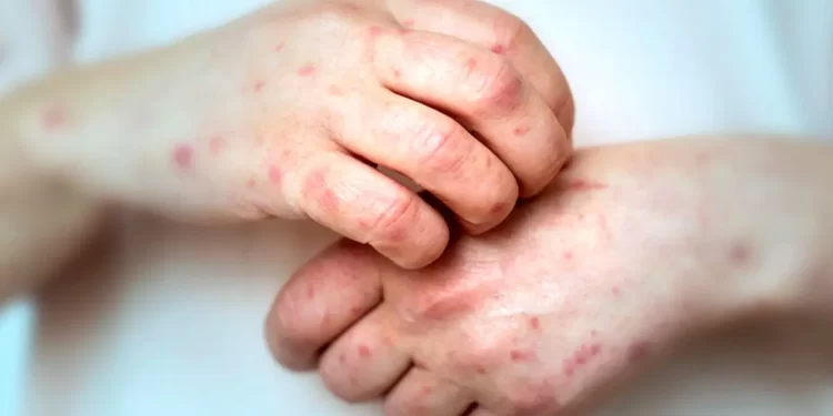 Argentina atraviesa un aumento sin precedentes en los casos de sífilis