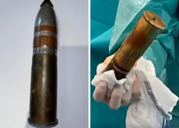 Joven llegó al hospital con una bala de la Primera Guerra Mundial en su recto