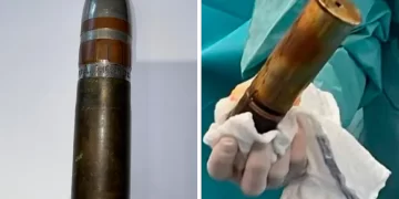 Joven llegó al hospital con una bala de la Primera Guerra Mundial en su recto