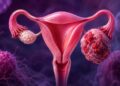 Cáncer de ovarios: el 70% de los casos se detecta en etapas avanzadas